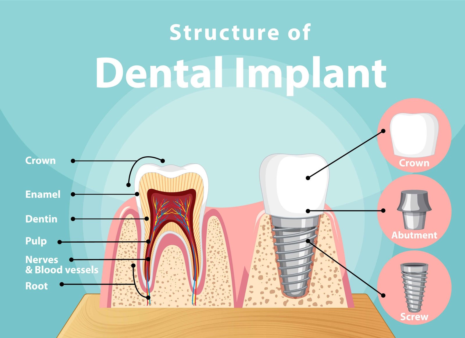 Types of Dental Implants diagram comparing a natural tooth and a dental implant, showing crown, abutment, and implant screw in the jawbone.