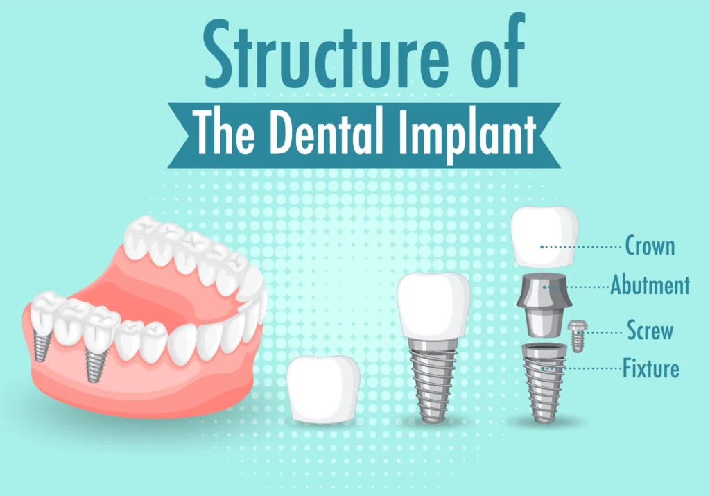 Types of Dental Implants infographic showing implant structure with crown, abutment, screw, and fixture, plus implants supporting teeth.