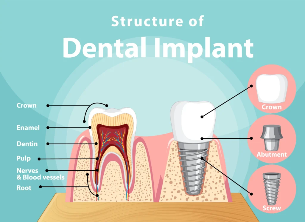 What are dental implants? Diagram showing implant structure (crown, abutment, screw) compared with a natural tooth anatomy.